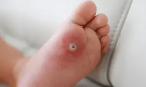 Małe, okrągłe zgrubienie na stopie dziecka, które wygląda jak kurzajka. Skóra wokół jest lekko zaczerwieniona.