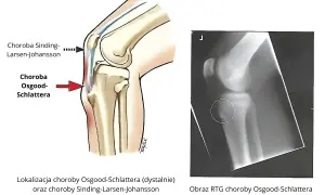Ilustracja anatomiczna i RTG kolana pokazujące lokalizację choroby Osgood-Schlattera.