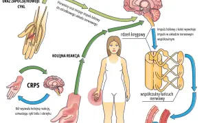 Cykl CRPS: uraz inicjuje impuls bólowy, który przez rdzeń kręgowy i mózg wywołuje reakcję współczulną, utrwalając ból i obrzęk.