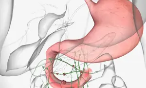 Widok anatomiczny żołądka i dwunastnicy z widocznymi guzkami wskazującymi na raka dwunastnicy oraz powiększone węzły chłonne.