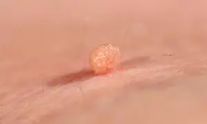 Zbliżenie na kłykciny kończyste, które przypominają małe, różowe różyczki na skórze. Widać drobne włoski wokół.