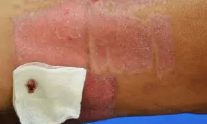 Skóra z widoczną martwicą, zaczerwienieniem i łuszczącym się naskórkiem. Obok opatrunek z gazy z plamą krwi.