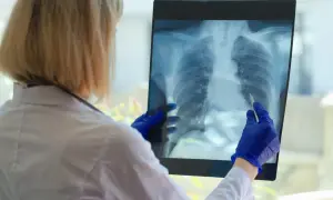 Lekarka w niebieskich rękawiczkach analizuje zdjęcie rentgenowskie płuc, wskazując na obszar sugerujący rozstrzenie oskrzeli.