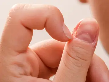 Dłoń z widocznymi zmianami skórnymi wokół paznokcia, wskazującymi na choroby paznokci.