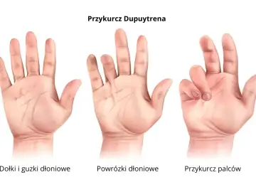 Trzy dłonie ilustrują postępujące stadia przykurczu Dupuytrena: od niewielkich guzków, przez powrózki, aż po zgięte palce.