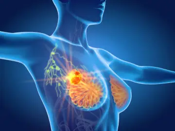 Anatomia piersi z widocznym guzem i powiększonymi węzłami chłonnymi, wskazującymi na limfadenopatię.