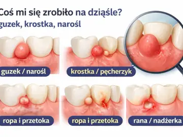 Ilustracja pokazuje różne stadia ropnia na dziąśle: guzek, krostkę, ropę i ranę.