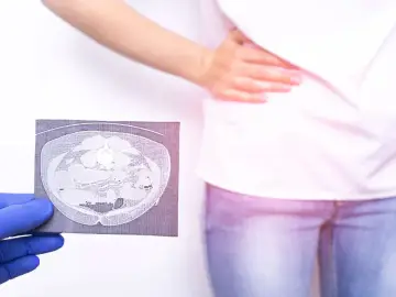 Lekarz w niebieskiej rękawiczce pokazuje tomografię komputerową jamy brzusznej, która może pomóc w diagnostyce zapalenia wyrostka robaczkowego. Pacjentka trzyma się za brzuch.