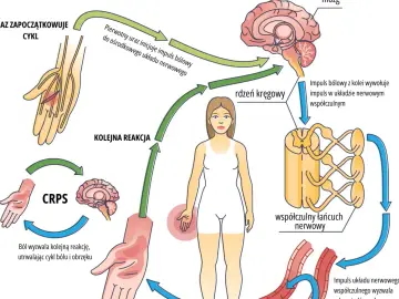Cykl CRPS: uraz inicjuje impuls bólowy, który przez rdzeń kręgowy i mózg wywołuje reakcję współczulną, utrwalając ból i obrzęk.
