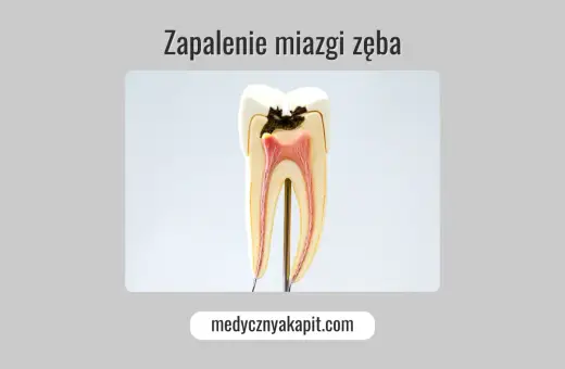 Model zęba ukazujący próchnicę sięgającą miazgi, co prowadzi do zapalenia miazgi.