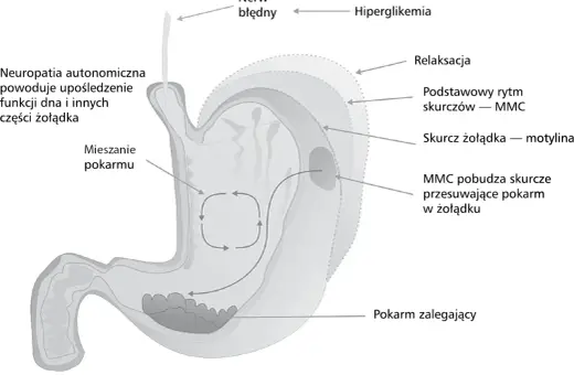 Opóźnione opróżnianie żołądka - Jak rozpoznać i leczyć gastroparezę?