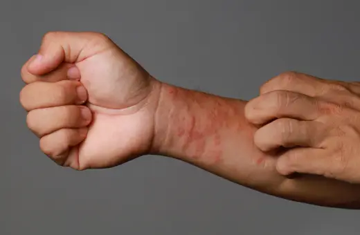 Rodzaje i objawy wysypki alergicznej - właściwa pielęgnacja skóry