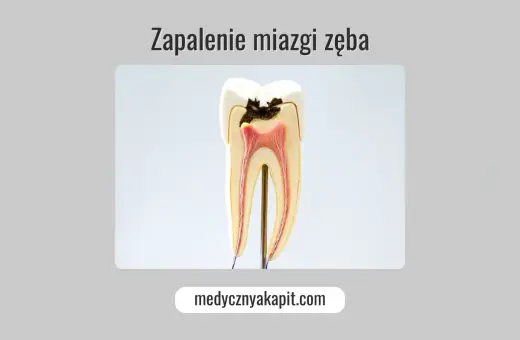 Model zęba ukazujący próchnicę sięgającą miazgi, co prowadzi do zapalenia miazgi.