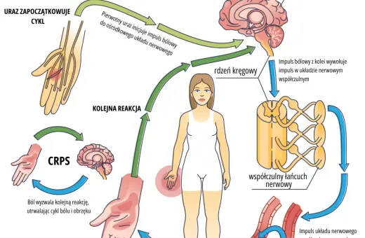 Cykl CRPS: uraz inicjuje impuls bólowy, który przez rdzeń kręgowy i mózg wywołuje reakcję współczulną, utrwalając ból i obrzęk.