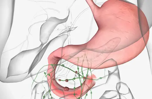 Widok anatomiczny żołądka i dwunastnicy z widocznymi guzkami wskazującymi na raka dwunastnicy oraz powiększone węzły chłonne.