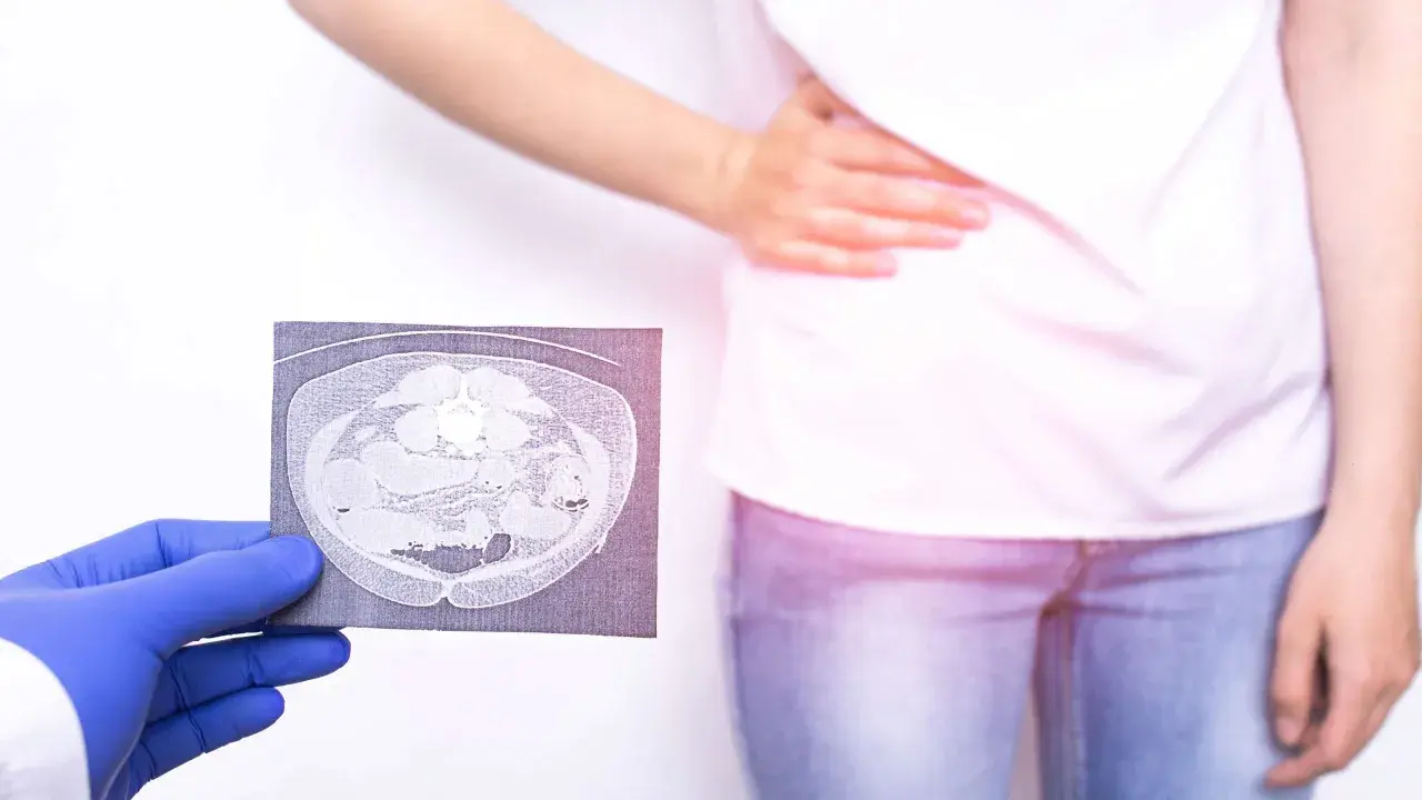 Lekarz w niebieskiej rękawiczce pokazuje tomografię komputerową jamy brzusznej, która może pomóc w diagnostyce zapalenia wyrostka robaczkowego. Pacjentka trzyma się za brzuch.