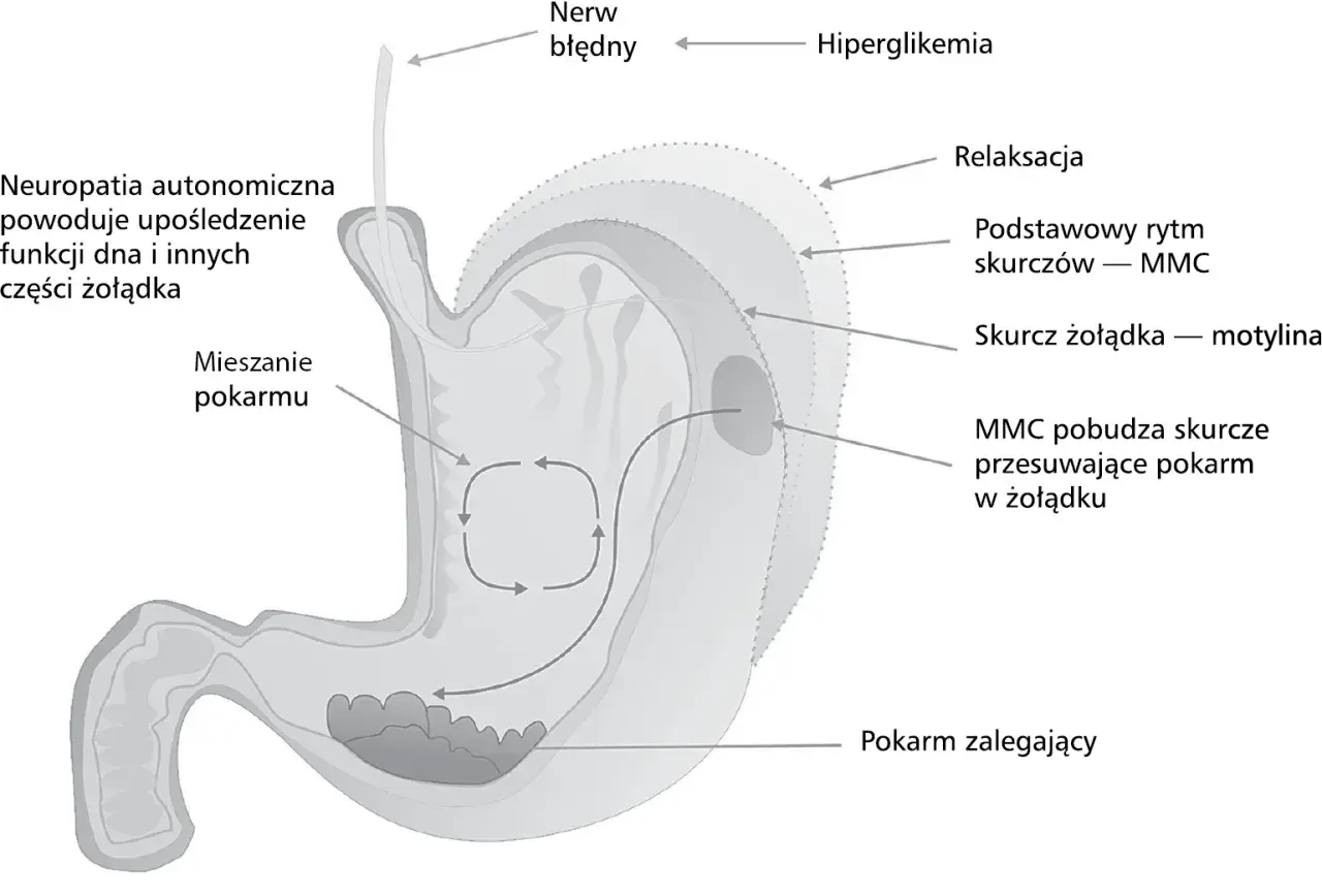 Opóźnione opróżnianie żołądka - Jak rozpoznać i leczyć gastroparezę?