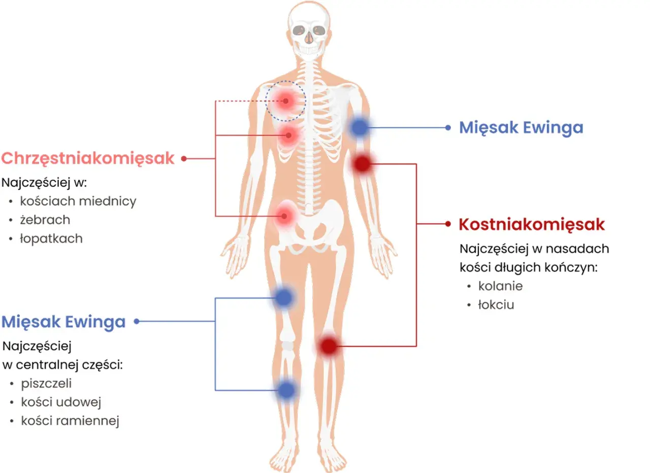 Schemat pokazuje lokalizację mięsaka Ewinga w centralnej części ciała, np. w piszczeli, kości udowej i ramiennej.