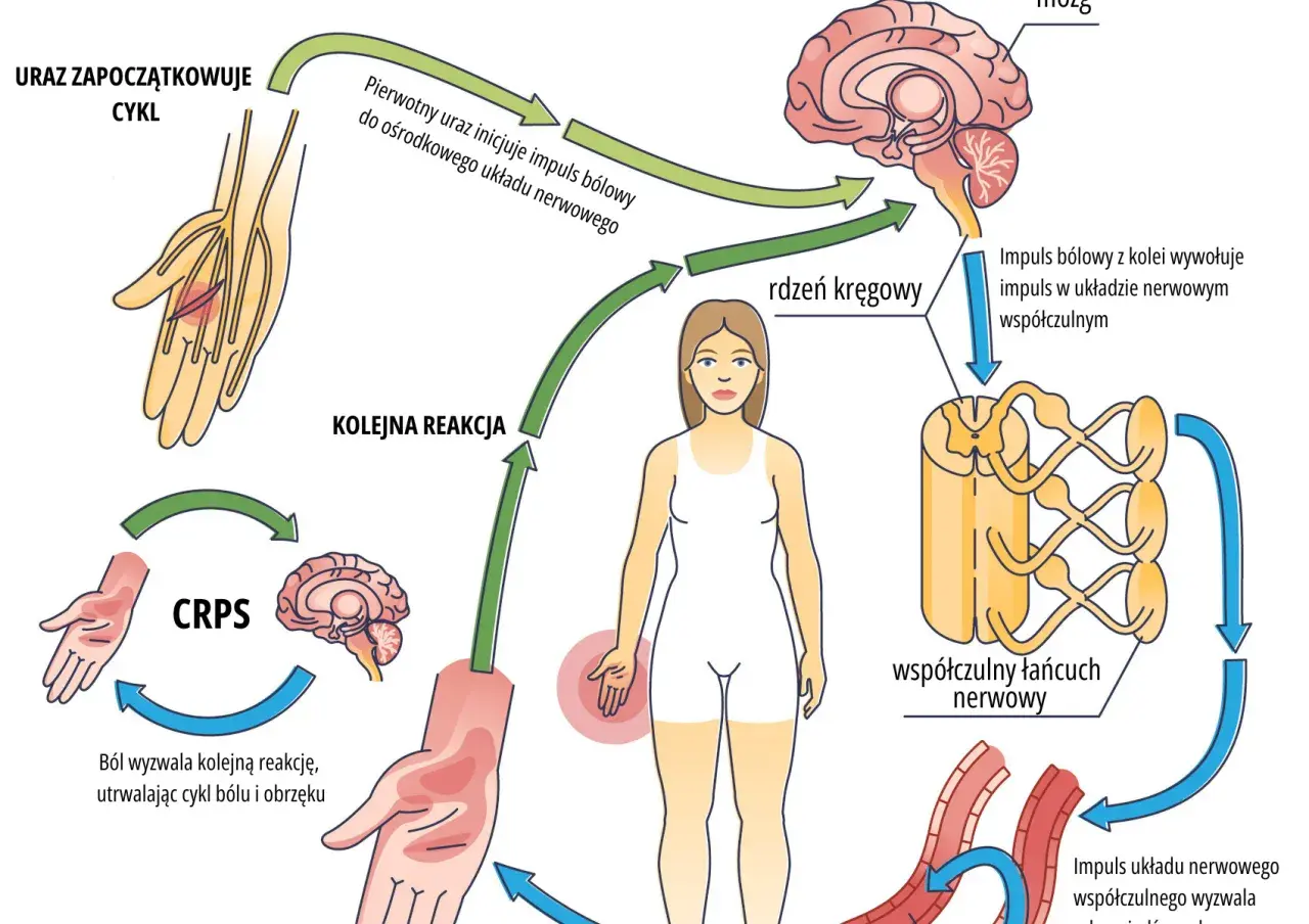 Cykl CRPS: uraz inicjuje impuls bólowy, który przez rdzeń kręgowy i mózg wywołuje reakcję współczulną, utrwalając ból i obrzęk.