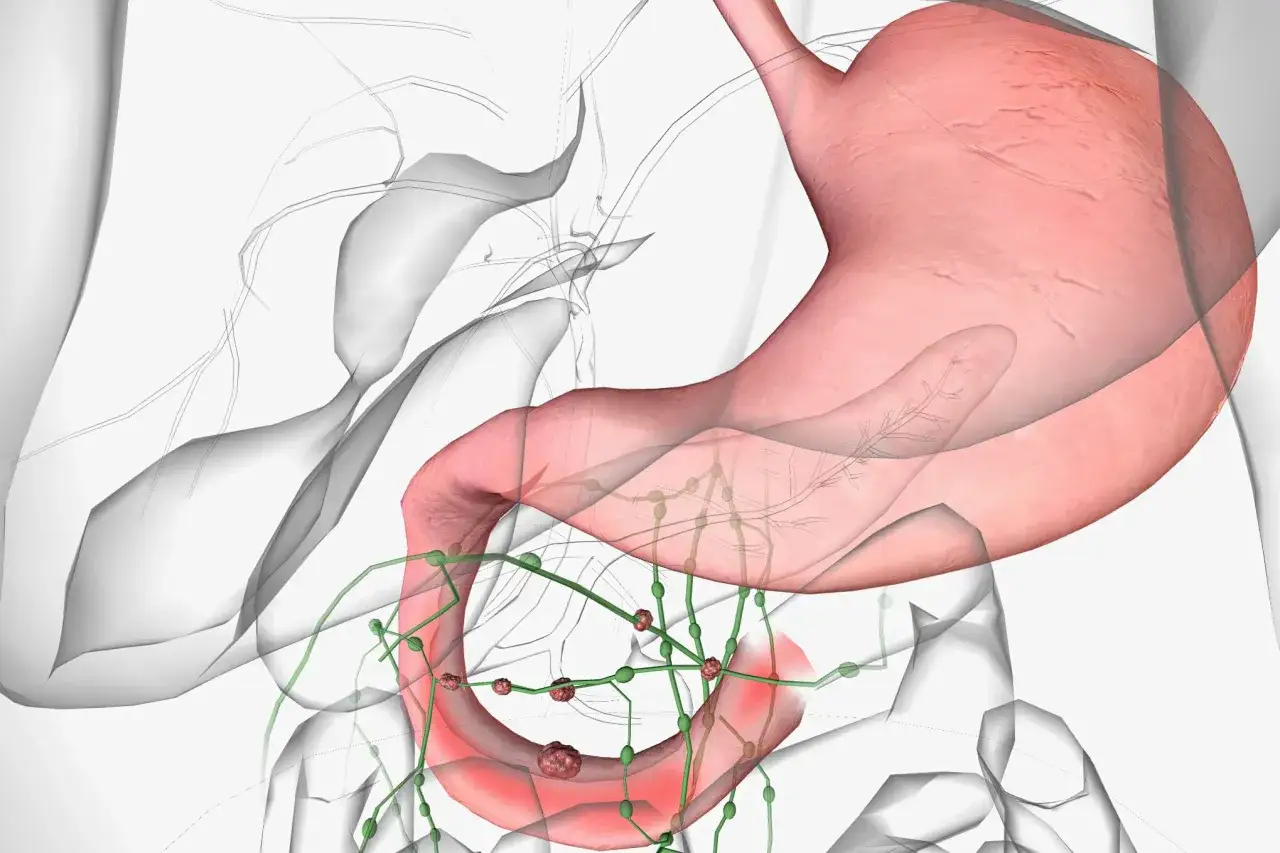 Widok anatomiczny żołądka i dwunastnicy z widocznymi guzkami wskazującymi na raka dwunastnicy oraz powiększone węzły chłonne.