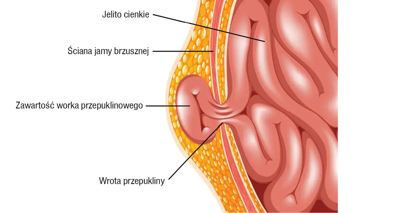 Przekrój jamy brzusznej ukazujący przepuklinę kresy białej. Jelito cienkie przechodzi przez wrota przepukliny, tworząc zawartość worka przepuklinowego.