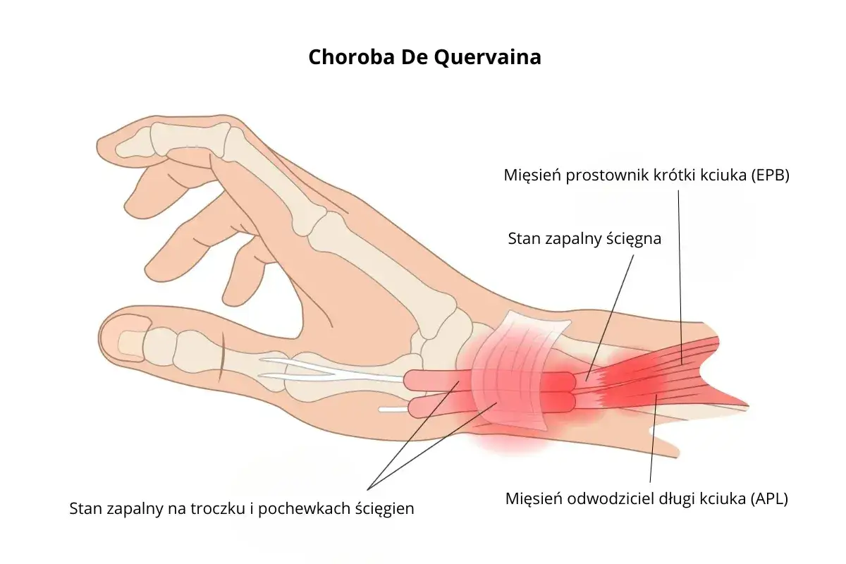 Anatomia dłoni z zaznaczonym stanem zapalnym ścięgien kciuka, objawem choroby De Quervaina.