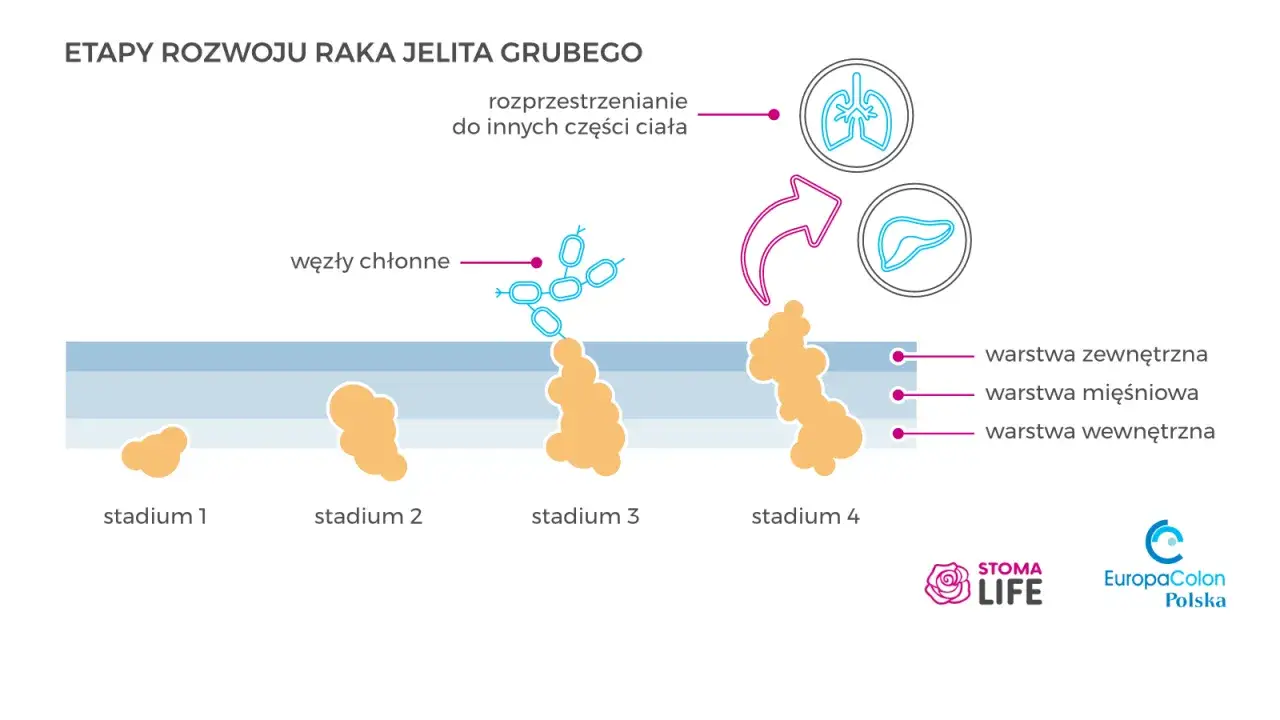 Ilustracja przedstawia etapy rozwoju raka jelita grubego, od stadium 1 do 4, z zaznaczonym rozprzestrzenianiem się do węzłów chłonnych, płuc i wątroby. Rokowania zależą od stadium.
